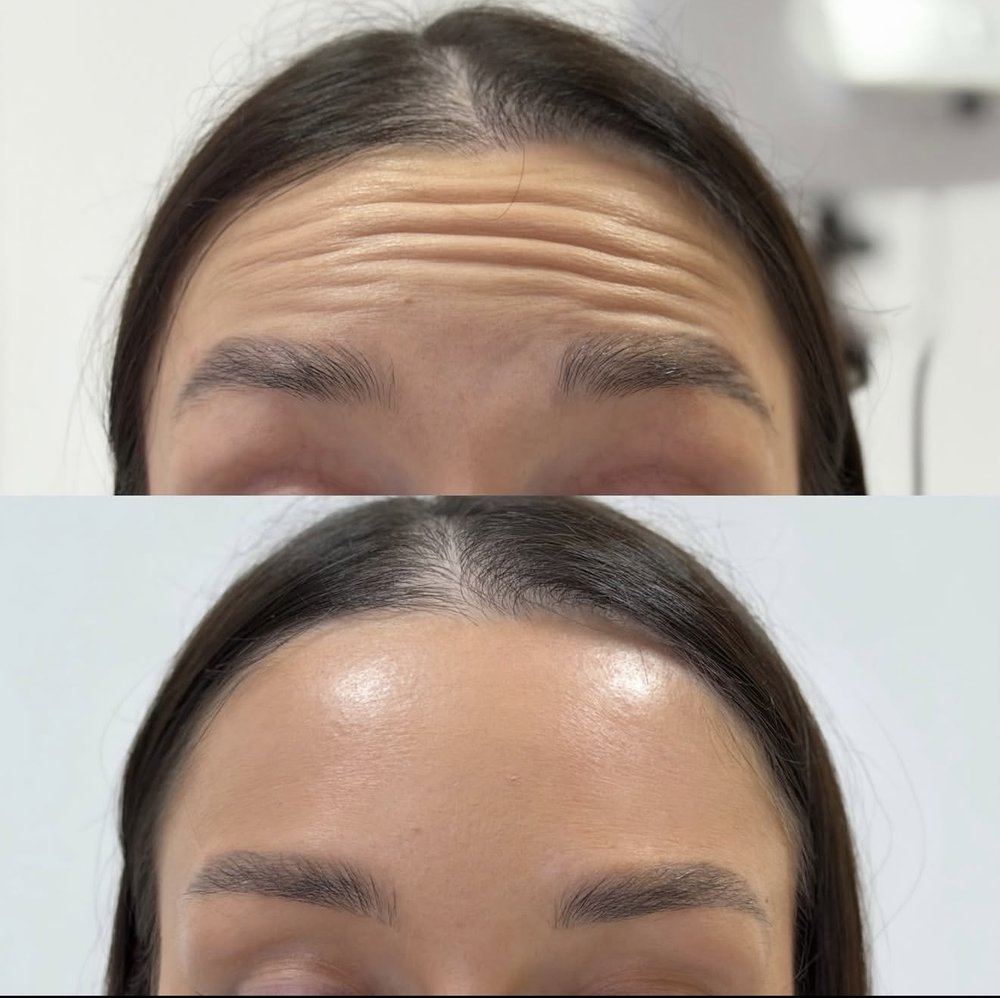 Botulinum therapy